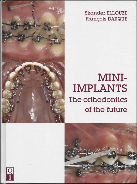 Mini-implants: The orthodontics of the future - American Journal of Orthodontics and Dentofacial ...