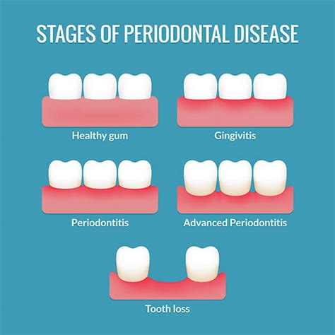 Periodontal Disease Stages