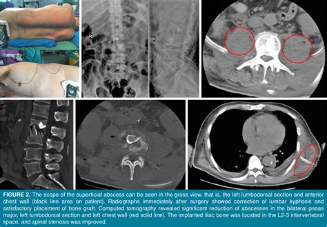 Figure 1 from A rare case of aggressive pyogenic spondylitis with giant ...