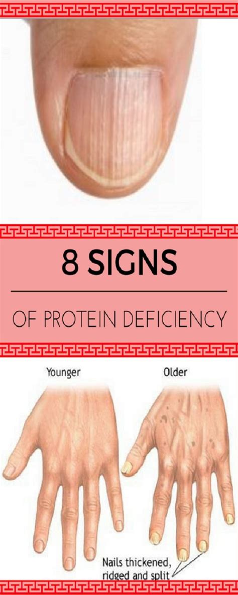 8 SIGNS OF PROTEIN DEFICIENCY | Herbal medicine, Natural remedies, Health