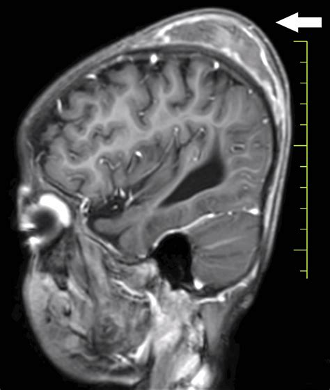 A Rare Case of a Subgaleal Hematoma With Global Developmental Delay, Scurvy, and Congenital ...