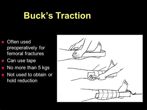 Bucks Traction