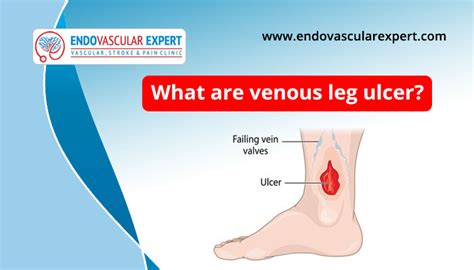 What is venous leg ulcer? | Endovascular Expert Jaipur