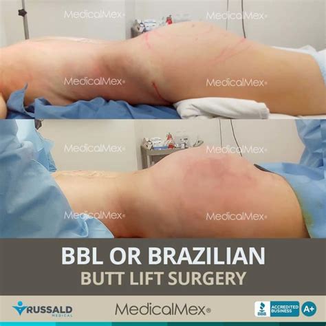 Brazilian Butt Lift Surgery in Tijuana, Mexico - MedicalMex