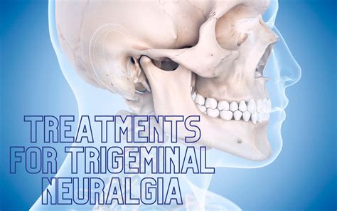 Treatments for trigeminal neuralgia - London Neurosurgery