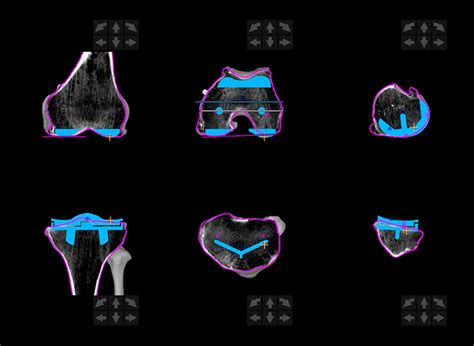 A solution for hip joint pain and knee joint pain | Stryker