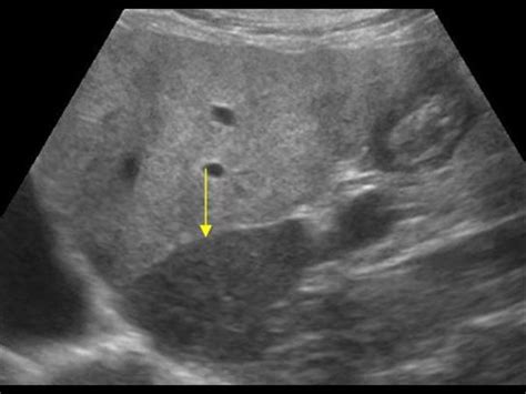 Abdomen and retroperitoneum | 1.1 Liver : Case 1.1.11 Fatty liver and focal sparing | Ultrasound ...