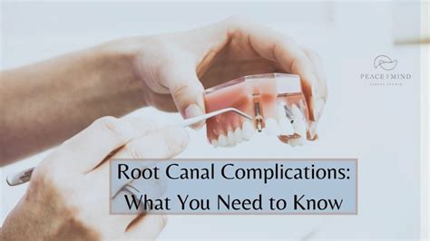 Root Canal Complications: What You Need to Know