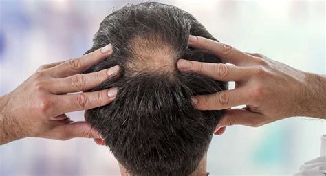 Hair Loss - Dr Sandra Cabot MD