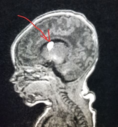 #Brain #MRI: 8 day old with a #bleed (#germinal matrix #hemorrhage). #radiology #radiologist ...