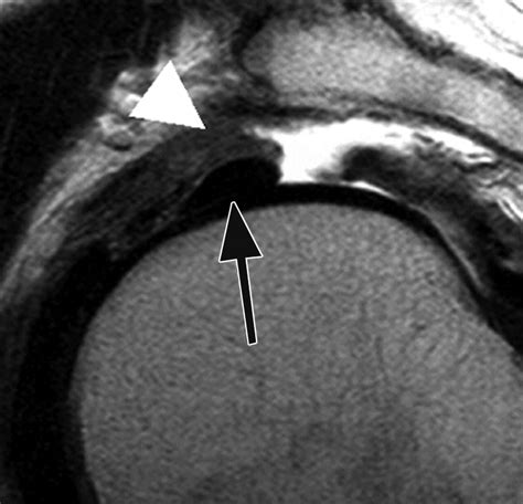 Coracohumeral Ligament Mri