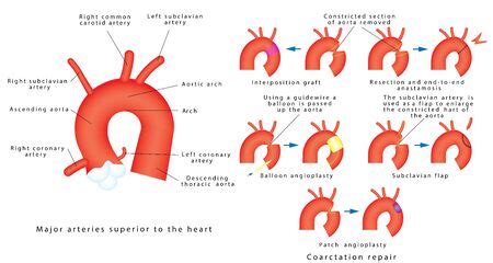 Coarctation repair. Coarctation of Aorta, congenital defect of the ...