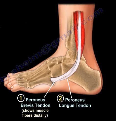 Peroneal Tendon Subluxation - Healthcare medicine Orthopedic Surgery Orthopaedics Medical Education