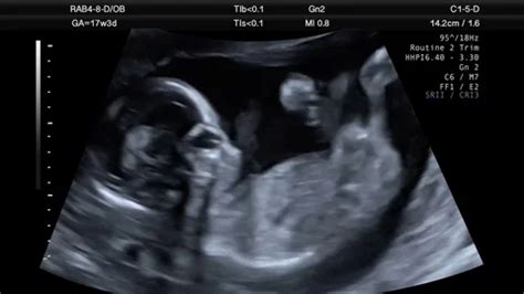 Ultrasound Scan Of 17 Week Old Fetus | Stock Video | Pond5