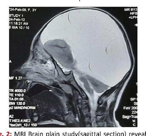 Hydranencephaly Mri