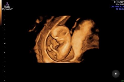 3D ultrasound; 10w 5d BOY?!? | BabyCenter