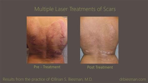 Treatment of Scarring - Brian Biesman MD | Nashville, TN