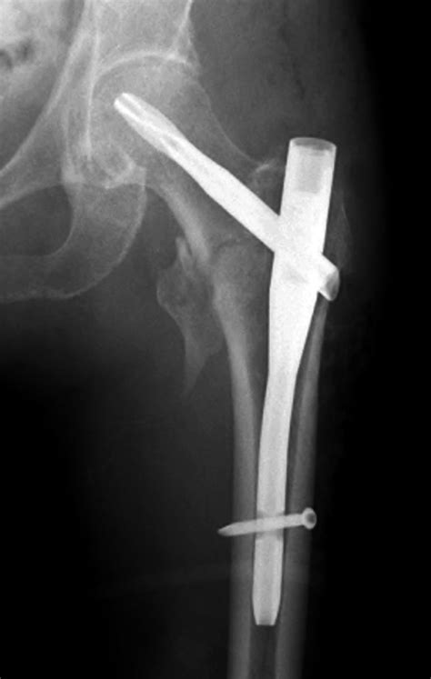 Imaging Guide To Orthopedic Devices An Introduction | Images and Photos finder