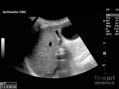 Diseased Gallbladder Ultrasound