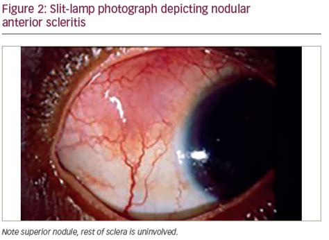 Scleritis—Infectious Versus Inflammatory - touchOPHTHALMOLOGY