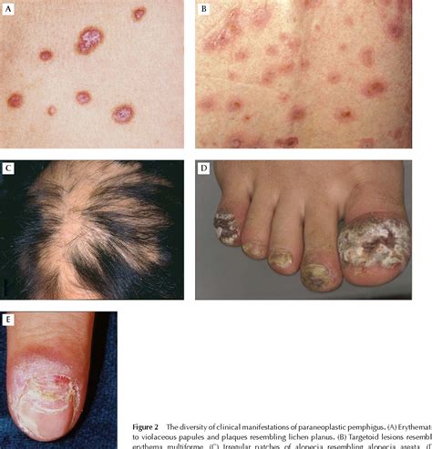 Figure 2 from Neoplasms associated with paraneoplastic pemphigus ...