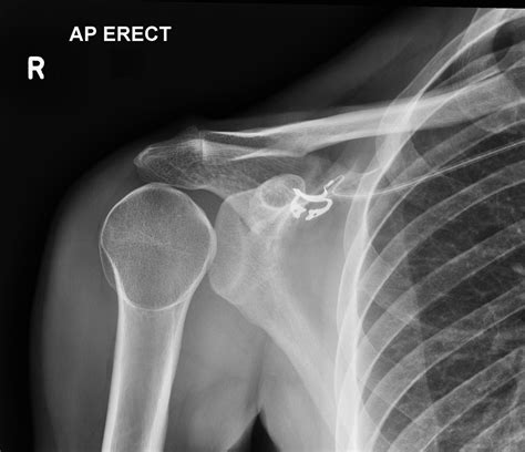 Shoulder Dislocation X Ray