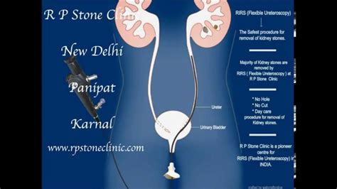 Animation of Kidney stone treatment by RIRS/ Flexible Ureteroscopy - YouTube