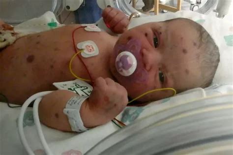 Baby born with rare 'blueberry muffin' cancer makes miracle recovery ...