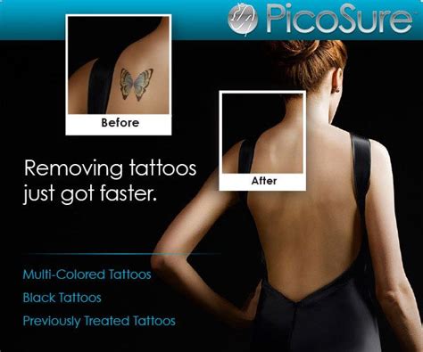 Picosure-Laser Tattoo Removal | Advanced Cosmetic Cincinnati