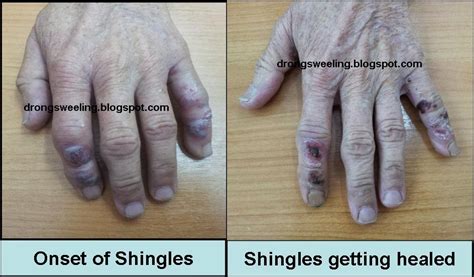 TCM News: Shingles (Herpes Zoster)带状疱疹(生蛇)