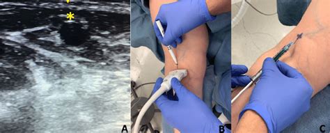 Preoperative ultrasound (US) localization over the cephalic vein. (A)... | Download Scientific ...