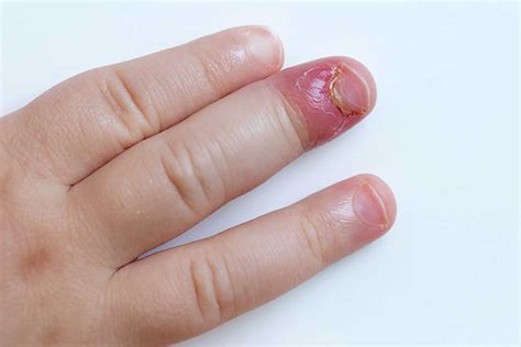 Acute and chronic paronychia causes, prevention & paronychia treatment