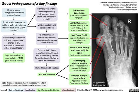 gout-pathogenesis-of-x-ray-findings | Calgary Guide