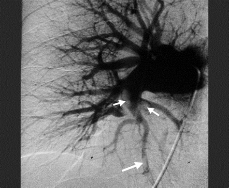 Pulmonary Embolism Diagnosis ~ akufisio.blogspot