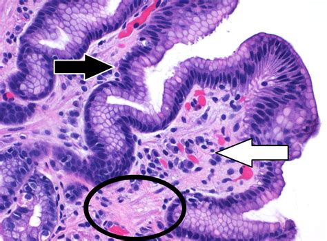 File:Histopathology of reactive gastropathy, annotated.jpg - HandWiki