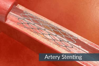 Superficial Femoral Artery Stenting | Dr Abhilash