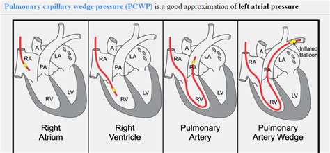 PULMONARY WEDGE PRESSURE (USMLE Step, 55% OFF