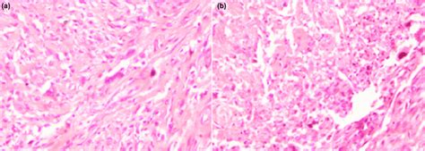 (a) High power microscopic image of osteogenic sarcoma demonstrating ...