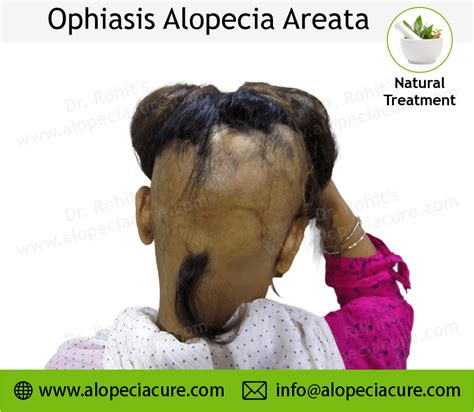 Ophiasis Alopecia Areata