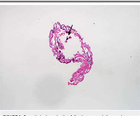 Figure 3 from Ultrasound Detection of Human Botfly Myiasis of the Scalp ...