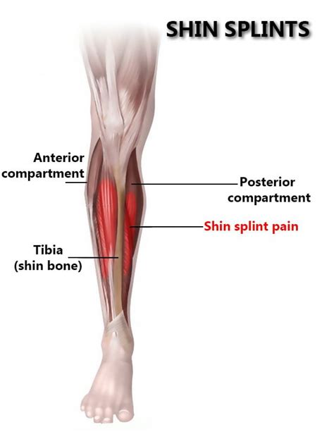 Shin Splints in NYC | New York Pain Care