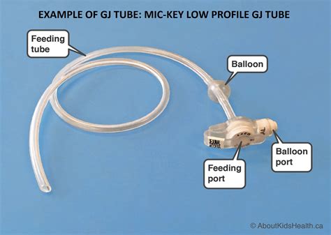 HINT: Do you know what type of enteral feeding tube the child has? — Connected Care @ SickKids