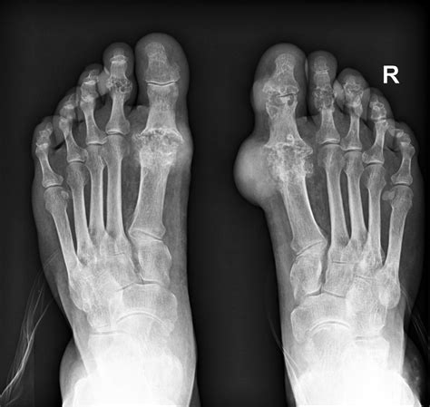 Gout: Symptoms, Causes & Diagnosis - The Foot Doc™