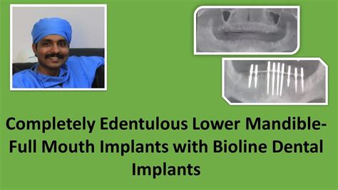 Completely Edentulous Lower Mandible-Full Mouth Implants With Bioline ...