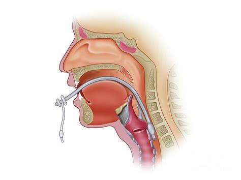 Orotracheal Intubation Photograph by Maurizio De Angelis/science Photo Library | Fine Art America