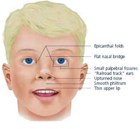 Down Syndrome - Pictures, Life Expectancy, Symptoms, Facts, Treatment