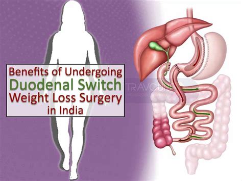 Benefits of Undergoing Duodenal Switch Weight Loss Surgery in India ~ Medical Tourism In India