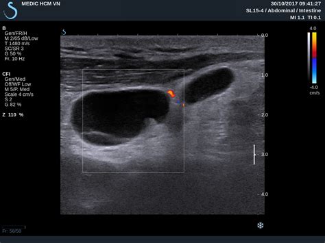 Reactive Lymph Nodes In Neck Ultrasound