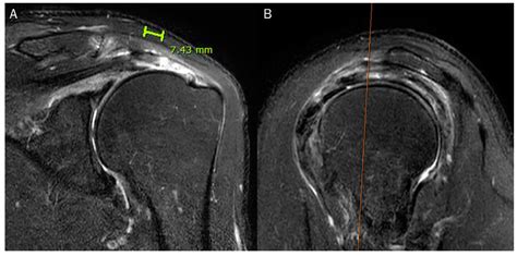 Mri Shoulder Tear