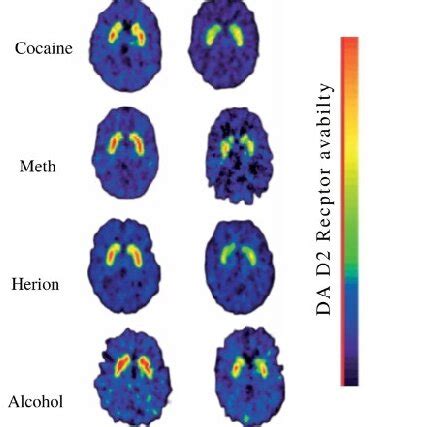 Dopamine D2 Receptors Are Lower in Addiction. An example of a PET scan... | Download Scientific ...